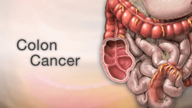 Colon Cancer