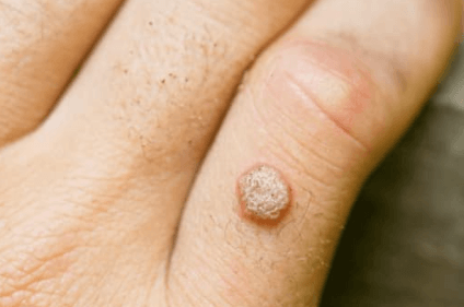 Benefits Of Homeopathic Wart Remover