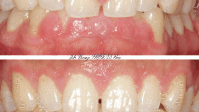 How Crown Lengthening Improves Both Function And Appearance
