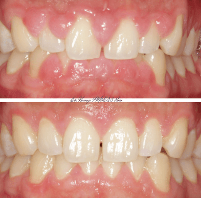 How Crown Lengthening Improves Both Function And Appearance