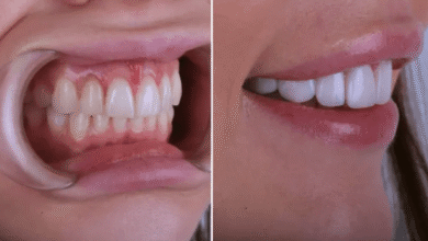 5 Advantages Of Porcelain Veneers Over Traditional Crowns