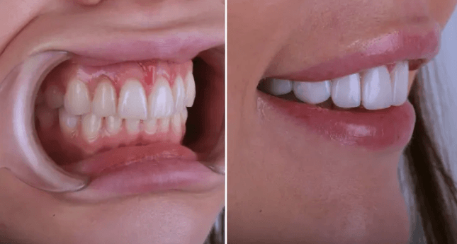 5 Advantages Of Porcelain Veneers Over Traditional Crowns